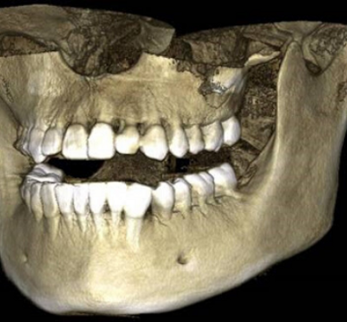 3D снимок челюстей (КТ)