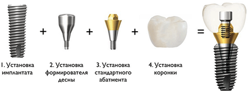 implantatsiya-zubov-bez-razreza-3